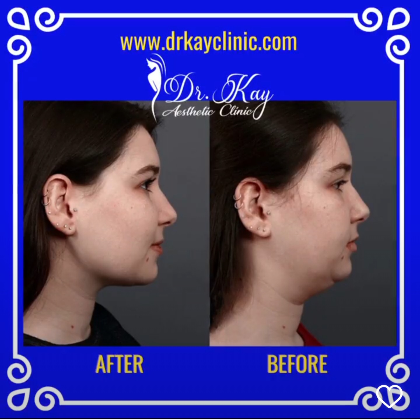 Double Chin Liposuction Dr Kay Clinic